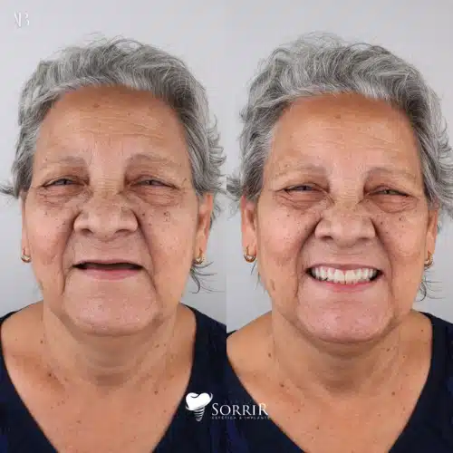antesedepois10
