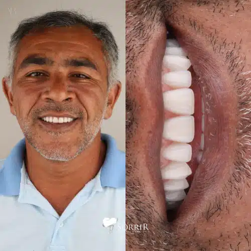 antesedepois13