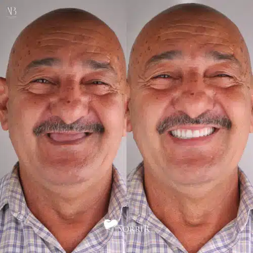 antesedepois15