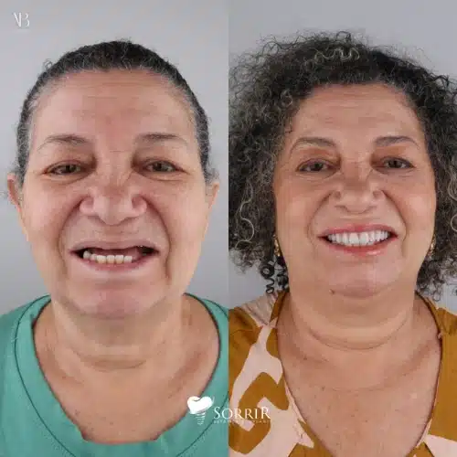 antesedepois6