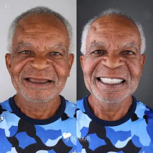 antesedepois7