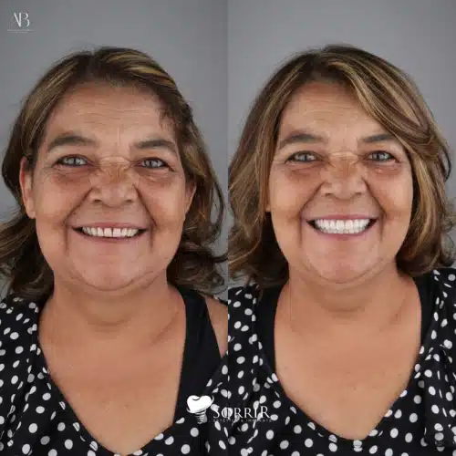 antesedepois8